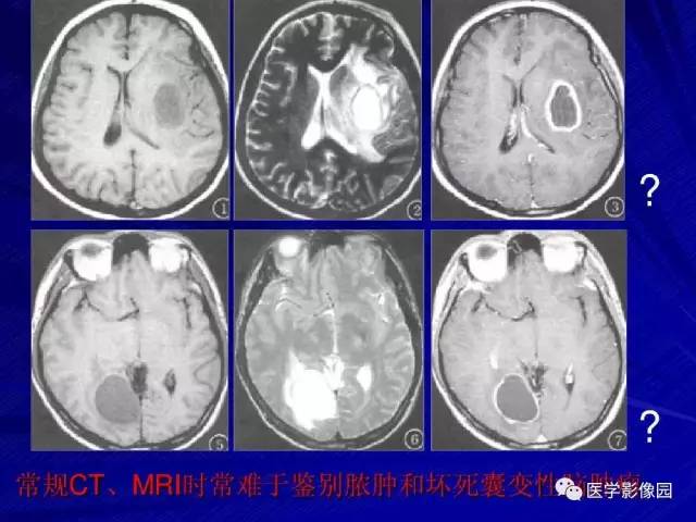 【PPT】颅内环状强化病变的影像学诊断及鉴别