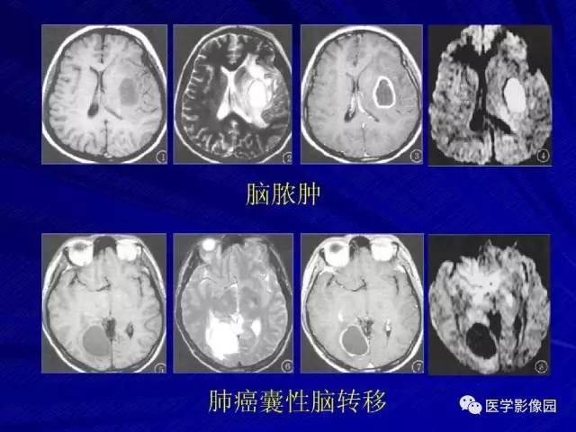 【PPT】颅内环状强化病变的影像学诊断及鉴别