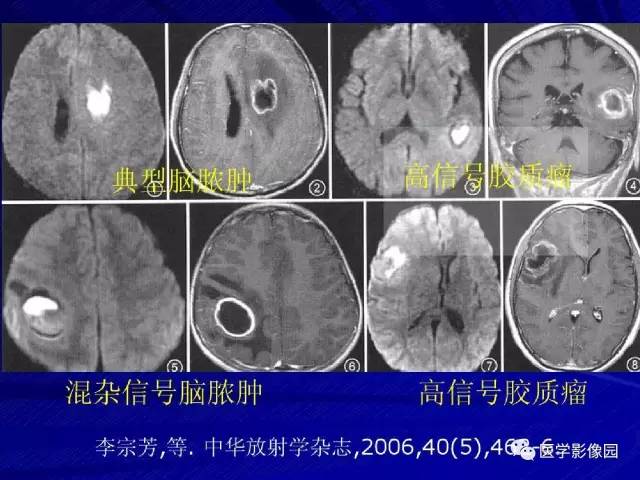 【PPT】颅内环状强化病变的影像学诊断及鉴别