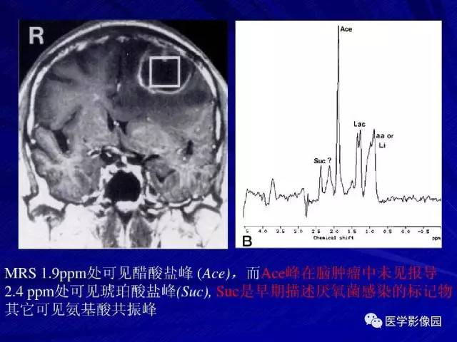 【PPT】颅内环状强化病变的影像学诊断及鉴别