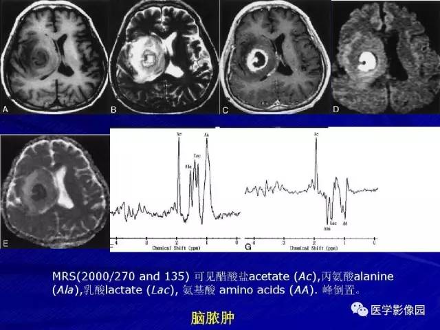 【PPT】颅内环状强化病变的影像学诊断及鉴别
