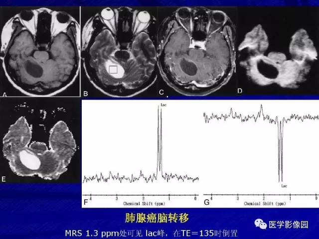 【PPT】颅内环状强化病变的影像学诊断及鉴别