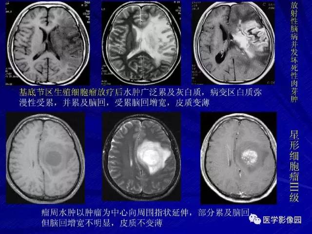 【PPT】颅内环状强化病变的影像学诊断及鉴别