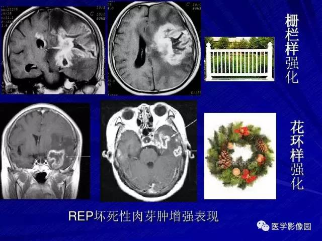 【PPT】颅内环状强化病变的影像学诊断及鉴别