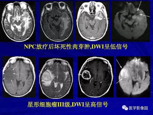 【PPT】颅内环状强化病变的影像学诊断及鉴别