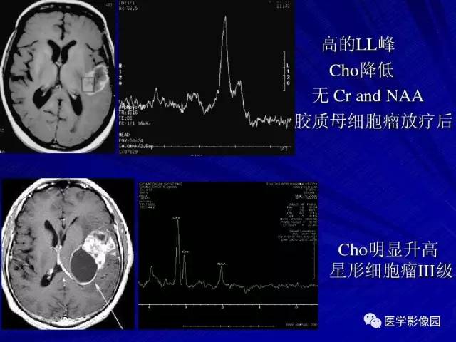 【PPT】颅内环状强化病变的影像学诊断及鉴别