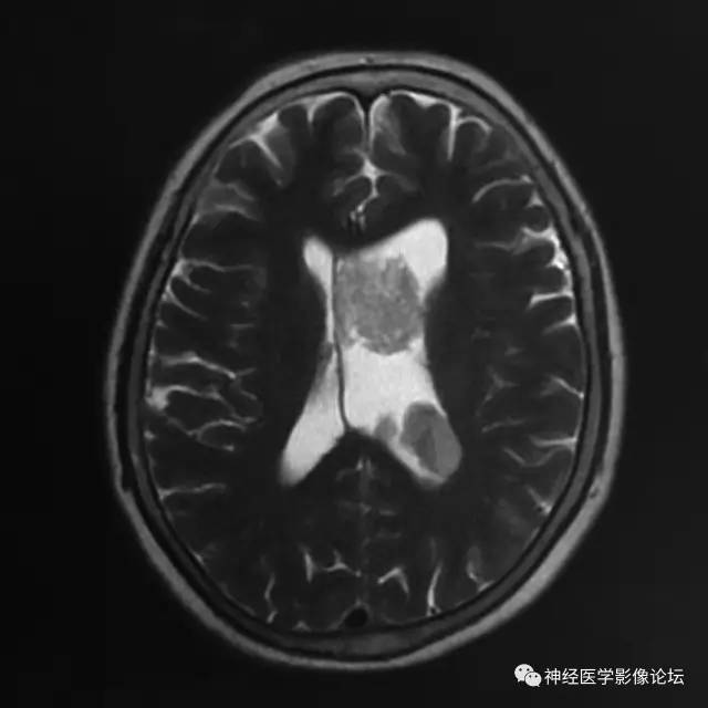 【病例】左侧脑室低级别星形细胞瘤1例MR影像表现
