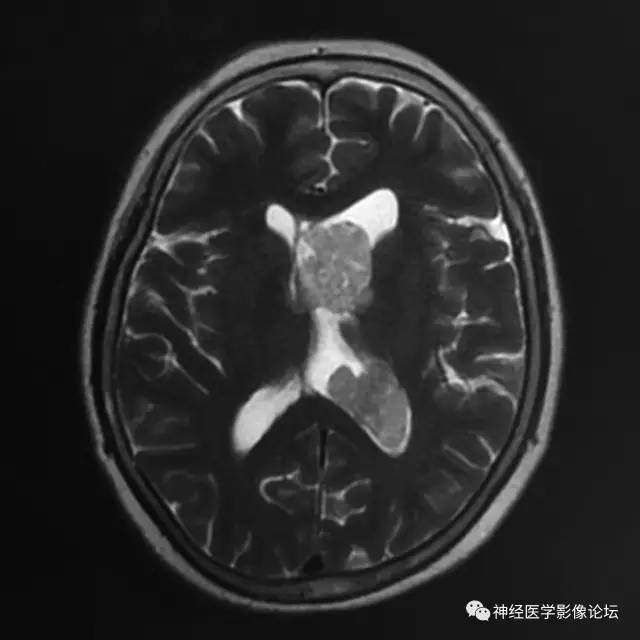 【病例】左侧脑室低级别星形细胞瘤1例MR影像表现