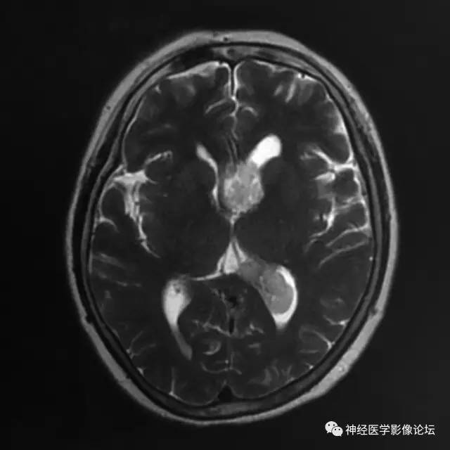 【病例】左侧脑室低级别星形细胞瘤1例MR影像表现