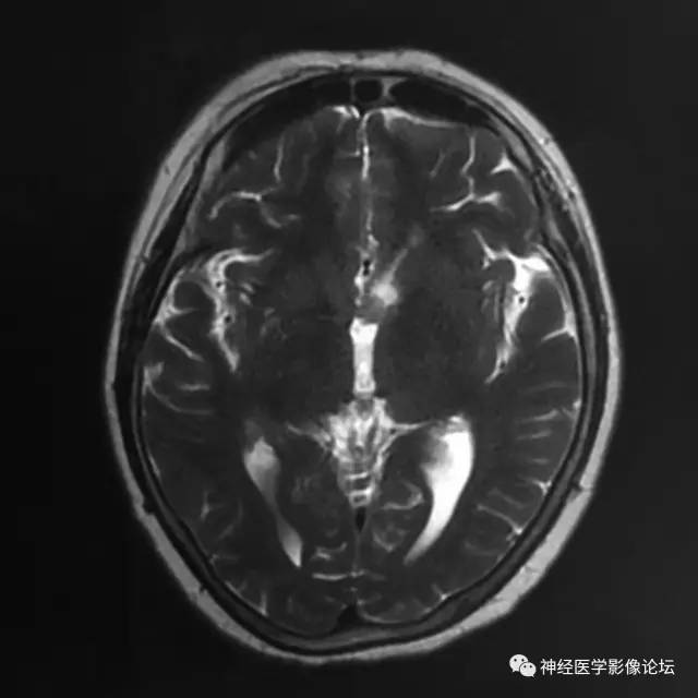 【病例】左侧脑室低级别星形细胞瘤1例MR影像表现