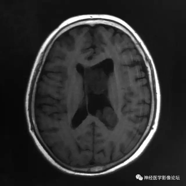【病例】左侧脑室低级别星形细胞瘤1例MR影像表现