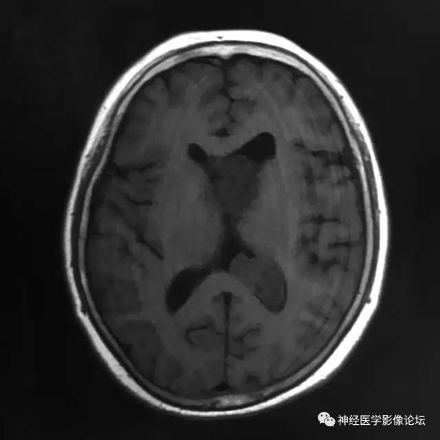 【病例】左侧脑室低级别星形细胞瘤1例MR影像表现