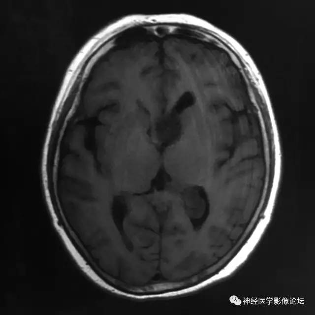 【病例】左侧脑室低级别星形细胞瘤1例MR影像表现