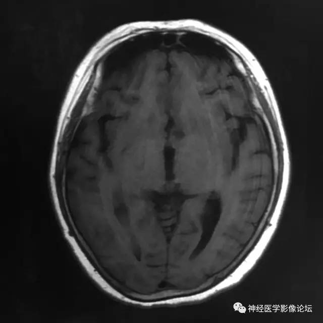 【病例】左侧脑室低级别星形细胞瘤1例MR影像表现