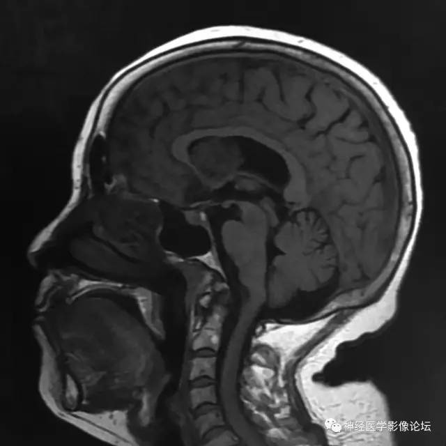 【病例】左侧脑室低级别星形细胞瘤1例MR影像表现
