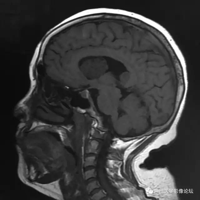 【病例】左侧脑室低级别星形细胞瘤1例MR影像表现