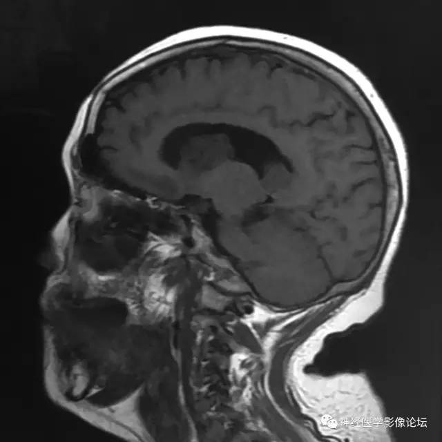 【病例】左侧脑室低级别星形细胞瘤1例MR影像表现