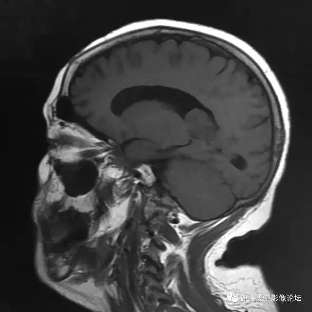 【病例】左侧脑室低级别星形细胞瘤1例MR影像表现