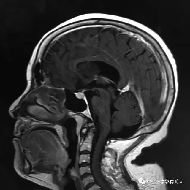 【病例】左侧脑室低级别星形细胞瘤1例MR影像表现