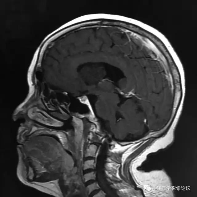 【病例】左侧脑室低级别星形细胞瘤1例MR影像表现