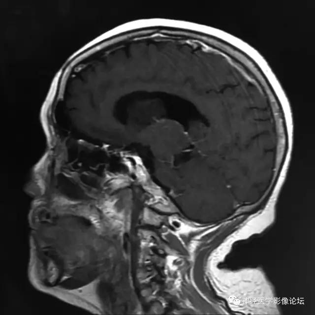 【病例】左侧脑室低级别星形细胞瘤1例MR影像表现