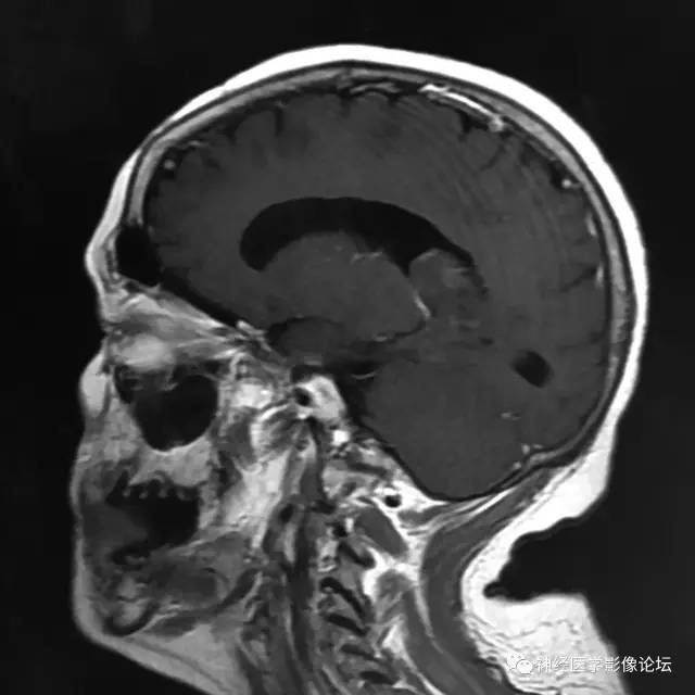 【病例】左侧脑室低级别星形细胞瘤1例MR影像表现