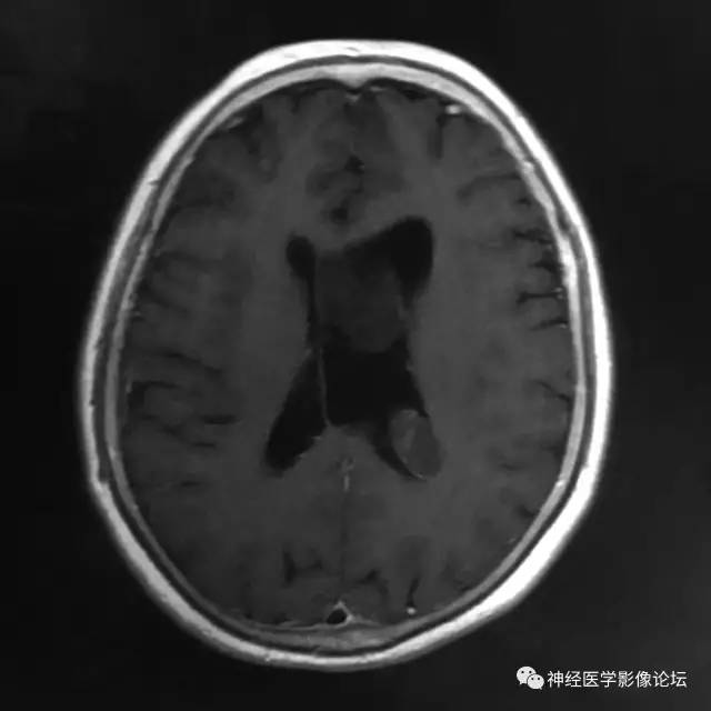 【病例】左侧脑室低级别星形细胞瘤1例MR影像表现