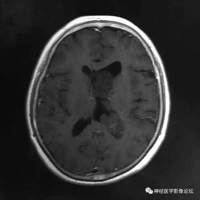 【病例】左侧脑室低级别星形细胞瘤1例MR影像表现