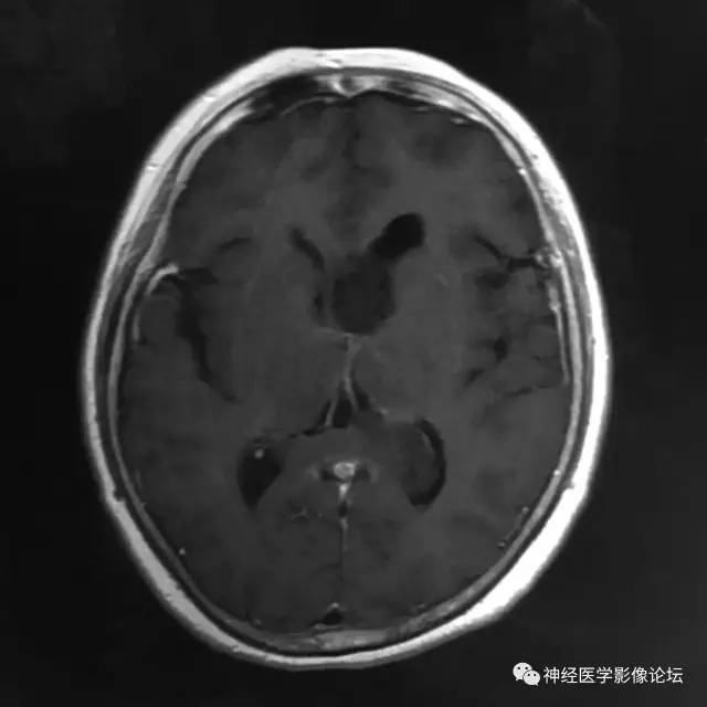 【病例】左侧脑室低级别星形细胞瘤1例MR影像表现