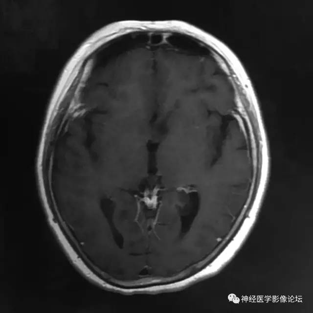 【病例】左侧脑室低级别星形细胞瘤1例MR影像表现