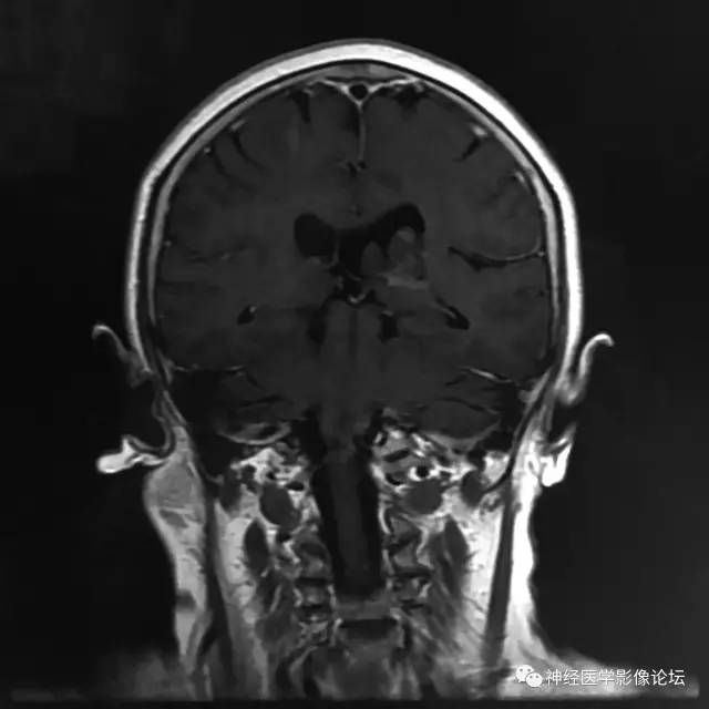 【病例】左侧脑室低级别星形细胞瘤1例MR影像表现