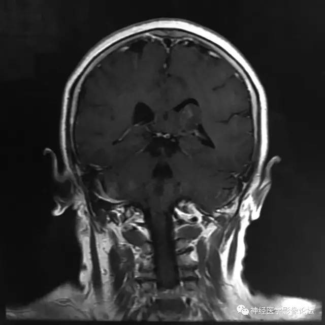 【病例】左侧脑室低级别星形细胞瘤1例MR影像表现