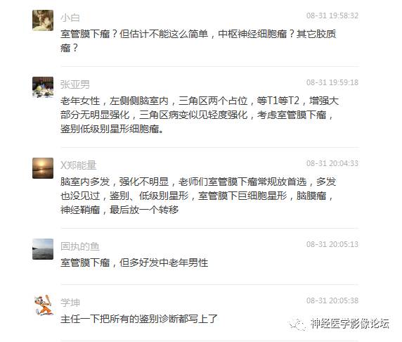 【病例】左侧脑室低级别星形细胞瘤1例MR影像表现