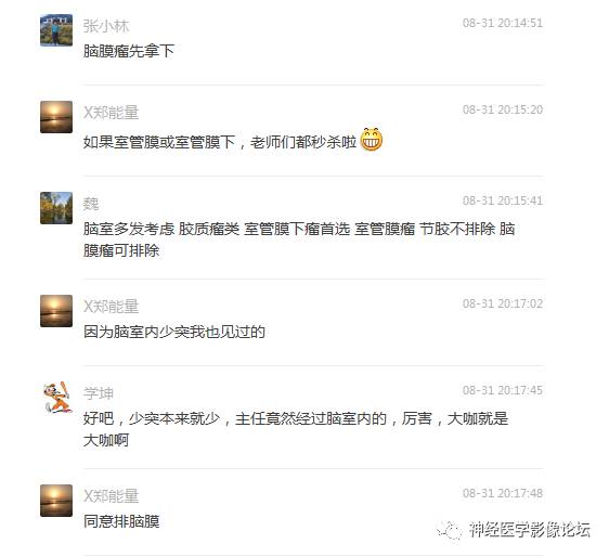 【病例】左侧脑室低级别星形细胞瘤1例MR影像表现