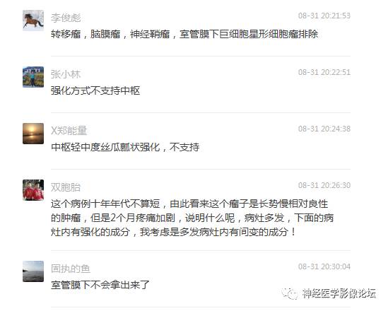 【病例】左侧脑室低级别星形细胞瘤1例MR影像表现