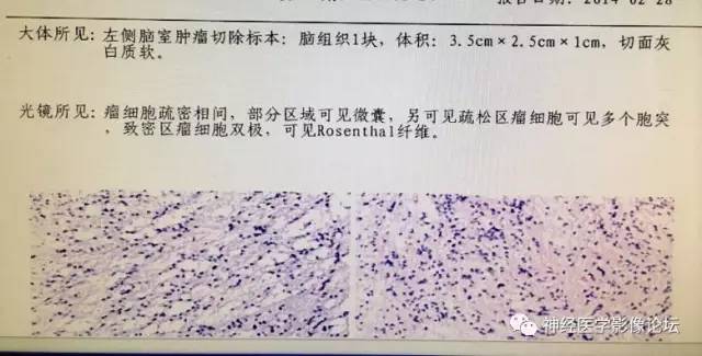 【病例】左侧脑室低级别星形细胞瘤1例MR影像表现