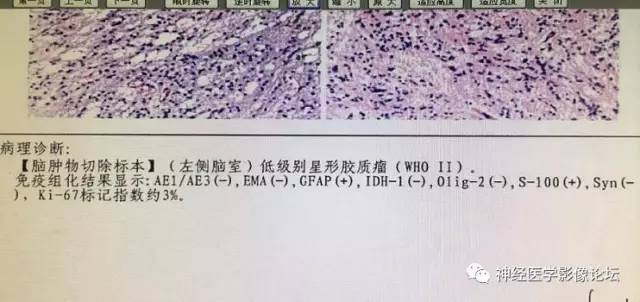 【病例】左侧脑室低级别星形细胞瘤1例MR影像表现