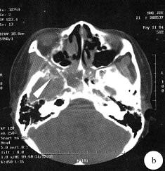 【病例】鼻腔嗅神经母细胞瘤1例CT及MR影像表现 【病例】鼻腔嗅神经母细胞瘤1例CT及MR影像表现