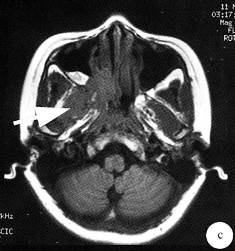 【病例】鼻腔嗅神经母细胞瘤1例CT及MR影像表现 【病例】鼻腔嗅神经母细胞瘤1例CT及MR影像表现