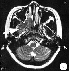 【病例】鼻腔嗅神经母细胞瘤1例CT及MR影像表现 【病例】鼻腔嗅神经母细胞瘤1例CT及MR影像表现