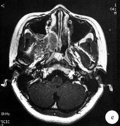 【病例】鼻腔嗅神经母细胞瘤1例CT及MR影像表现 【病例】鼻腔嗅神经母细胞瘤1例CT及MR影像表现