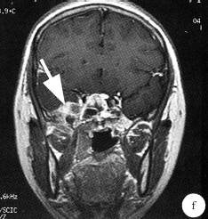 【病例】鼻腔嗅神经母细胞瘤1例CT及MR影像表现 【病例】鼻腔嗅神经母细胞瘤1例CT及MR影像表现