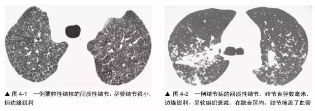 多发结节的HRCT鉴别诊断 多发结节的HRCT鉴别诊断