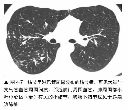 多发结节的HRCT鉴别诊断 多发结节的HRCT鉴别诊断