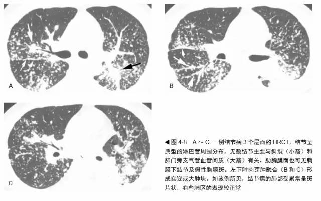 多发结节的HRCT鉴别诊断 多发结节的HRCT鉴别诊断