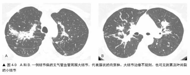 多发结节的HRCT鉴别诊断 多发结节的HRCT鉴别诊断