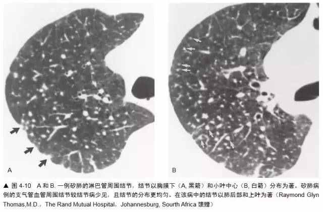 多发结节的HRCT鉴别诊断 多发结节的HRCT鉴别诊断