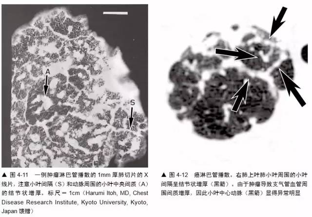 多发结节的HRCT鉴别诊断 多发结节的HRCT鉴别诊断
