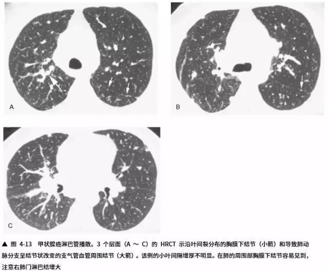 多发结节的HRCT鉴别诊断 多发结节的HRCT鉴别诊断