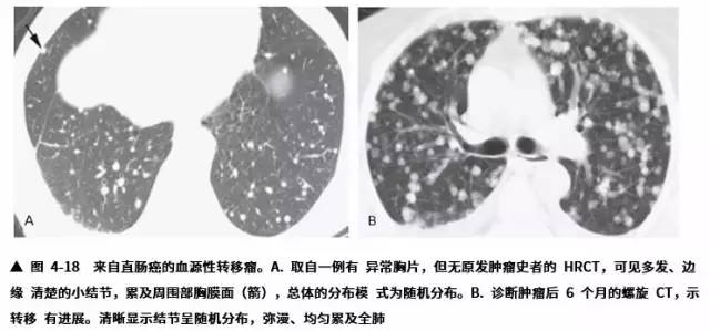 多发结节的HRCT鉴别诊断 多发结节的HRCT鉴别诊断